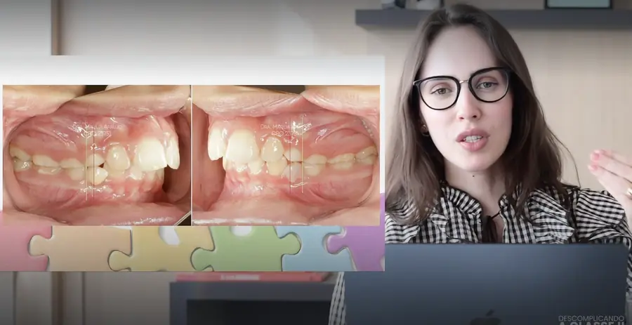 Descomplicando a Classe II · Diagnóstico da Classe II