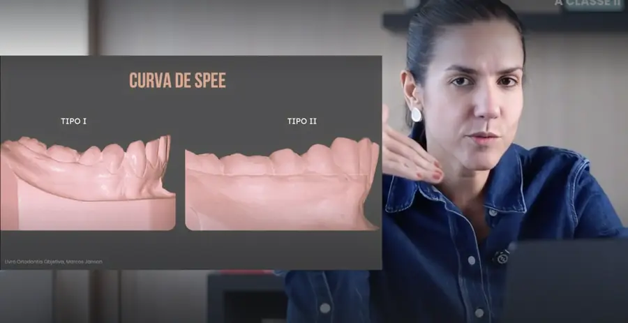 Descomplicando a Classe II · Curva de Spee